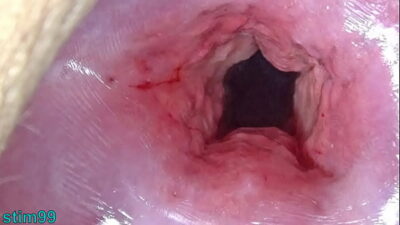 Japan Mom Cervix Open Wide Dilatation And Fucking Uterus With Insertion Of Huge Objects 400x225 adult video thumbnail